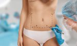 Plastic surgery doctor draw line on patient breast augmentation implant. Woman belly marked out for cosmetic surgery in surgery room interior